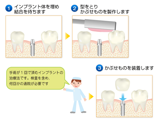 インプラント治療の流れ(1回法)