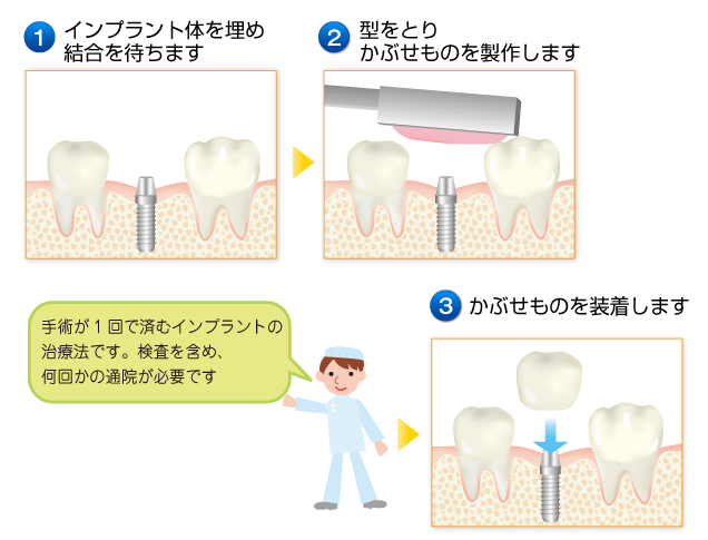 インプラント治療の流れ（1回法）