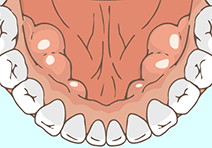 下顎の内側に骨の出っ張りがあるイメージ